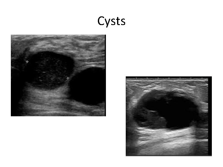 Cysts 