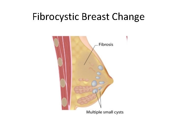 Fibrocystic Breast Change 