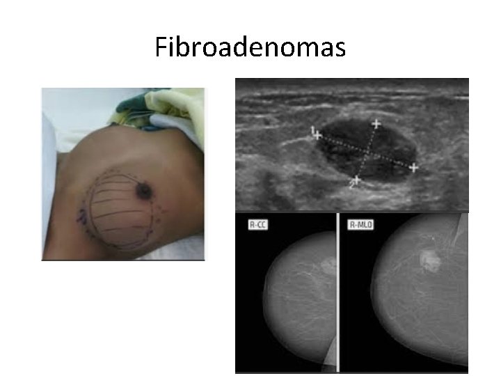 Fibroadenomas 