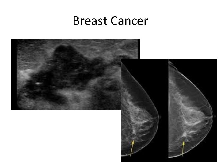 Breast Cancer 