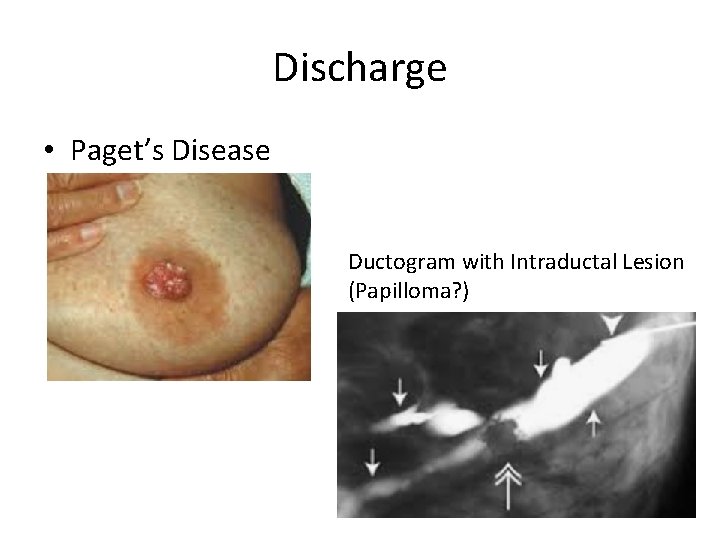 Discharge • Paget’s Disease Ductogram with Intraductal Lesion (Papilloma? ) 