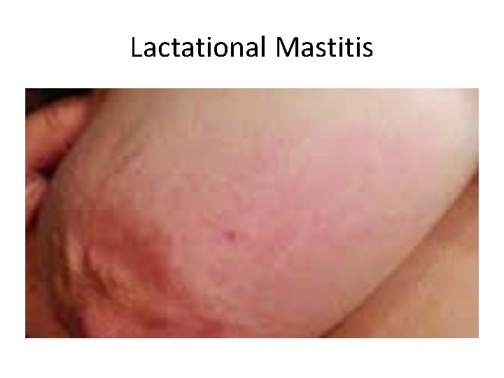 Lactational Mastitis 