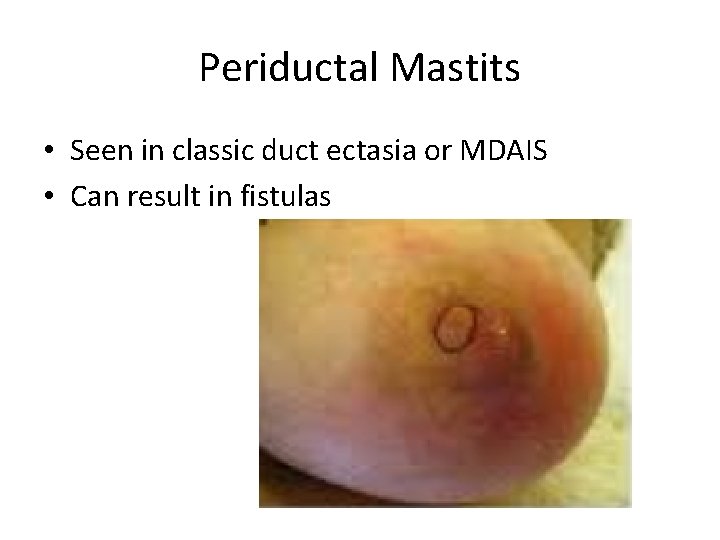 Periductal Mastits • Seen in classic duct ectasia or MDAIS • Can result in