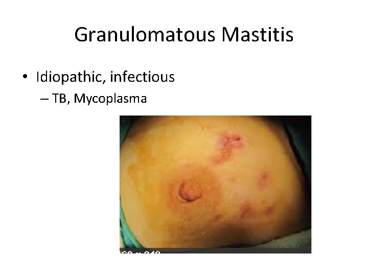 Granulomatous Mastitis • Idiopathic, infectious – TB, Mycoplasma 