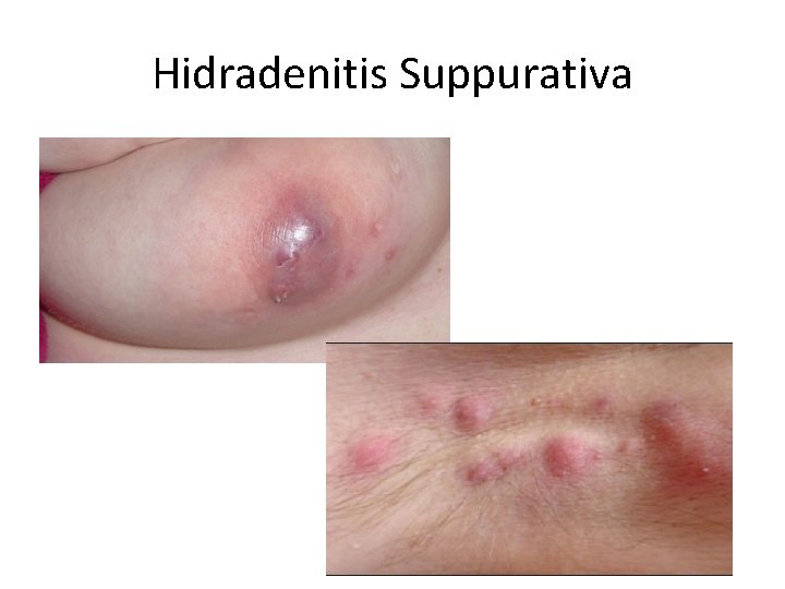 Hidradenitis Suppurativa 