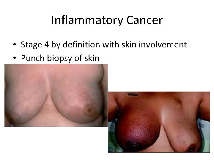 Inflammatory Cancer • Stage 4 by definition with skin involvement • Punch biopsy of
