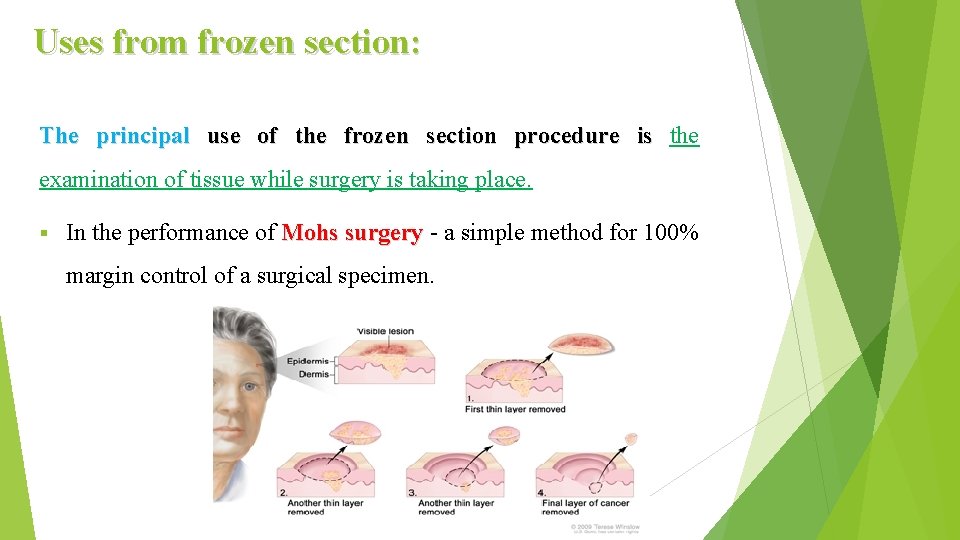 Uses from frozen section: The principal use of the frozen section procedure is the