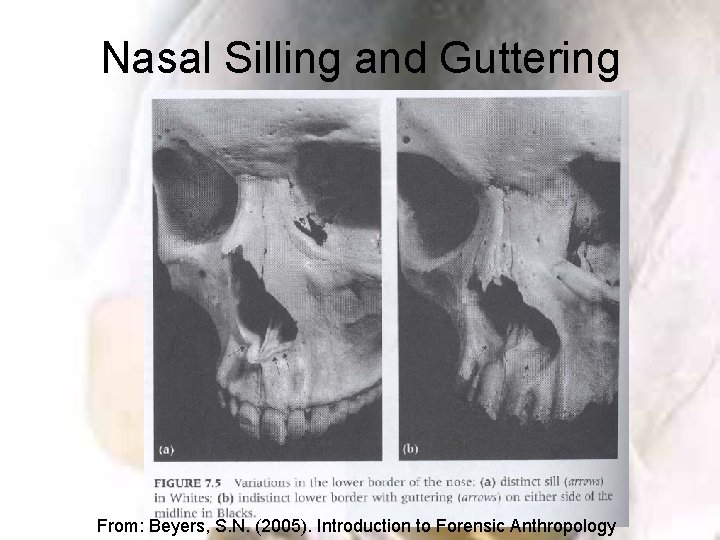 Nasal Silling and Guttering From: Beyers, S. N. (2005). Introduction to Forensic Anthropology 