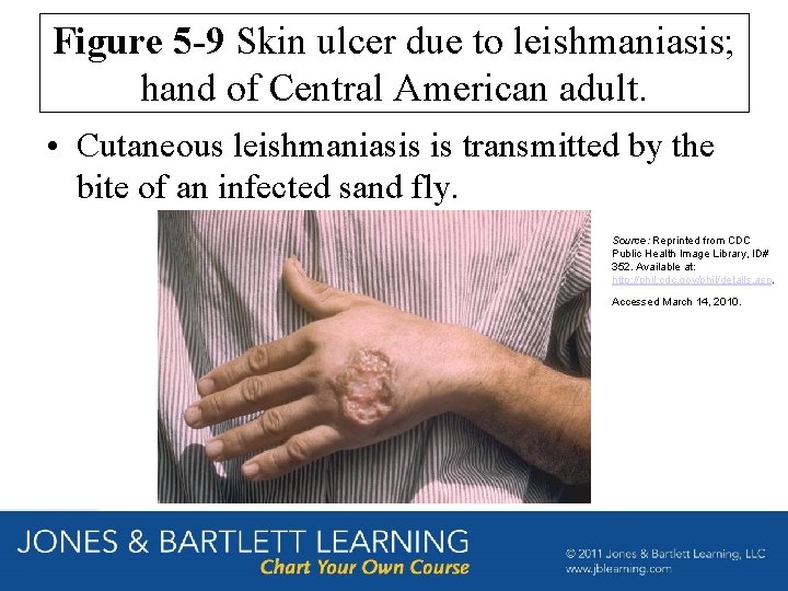 Figure 5 -9 Skin ulcer due to leishmaniasis; hand of Central American adult. •
