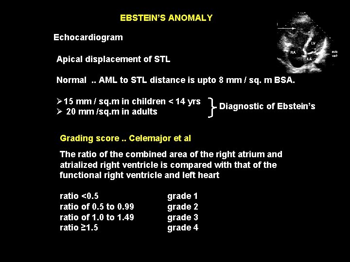EBSTEIN’S ANOMALY Echocardiogram Apical displacement of STL Normal. . AML to STL distance is
