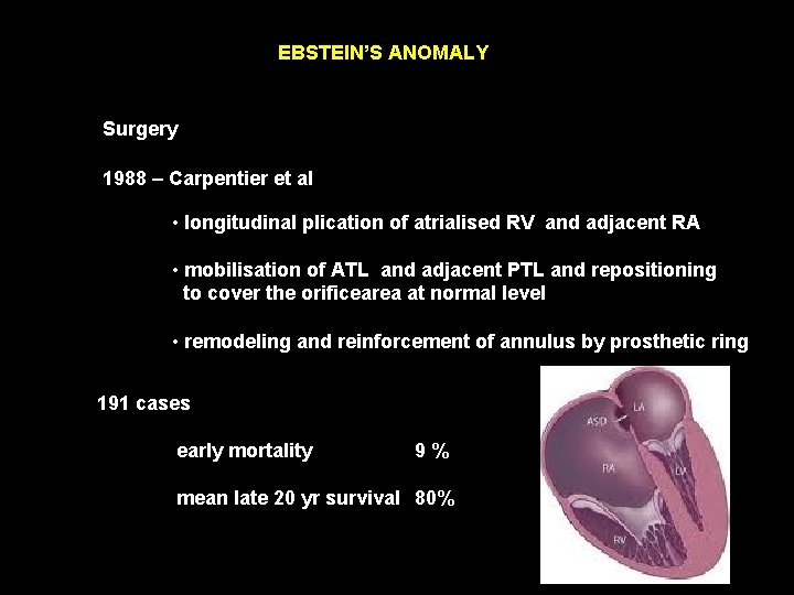 EBSTEIN’S ANOMALY Surgery 1988 – Carpentier et al • longitudinal plication of atrialised RV