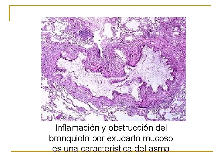 Inflamación y obstrucción del bronquiolo por exudado mucoso es una caracteristica del asma 