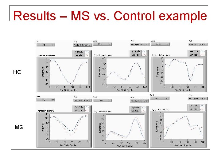 Results – MS vs. Control example HC MS 