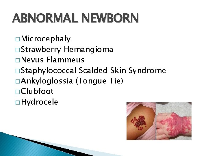 ABNORMAL NEWBORN � Microcephaly � Strawberry Hemangioma � Nevus Flammeus � Staphylococcal Scalded Skin