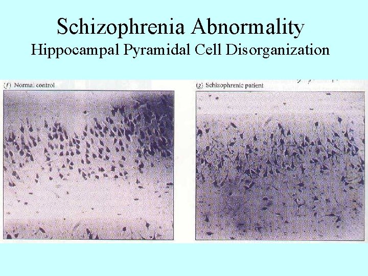 Schizophrenia Abnormality Hippocampal Pyramidal Cell Disorganization 