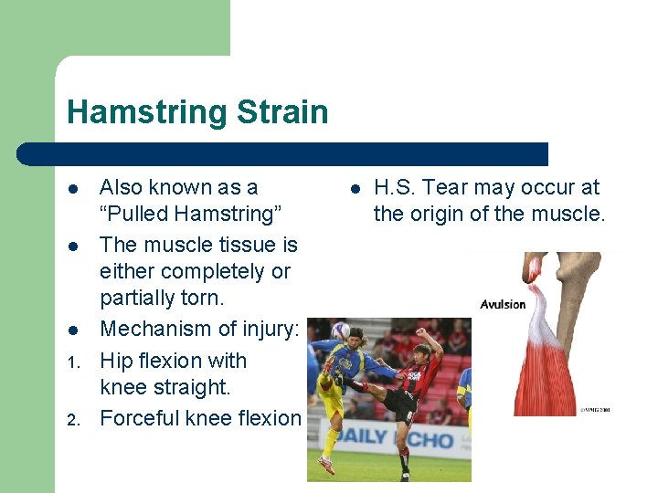 Hamstring Strain l l l 1. 2. Also known as a “Pulled Hamstring” The