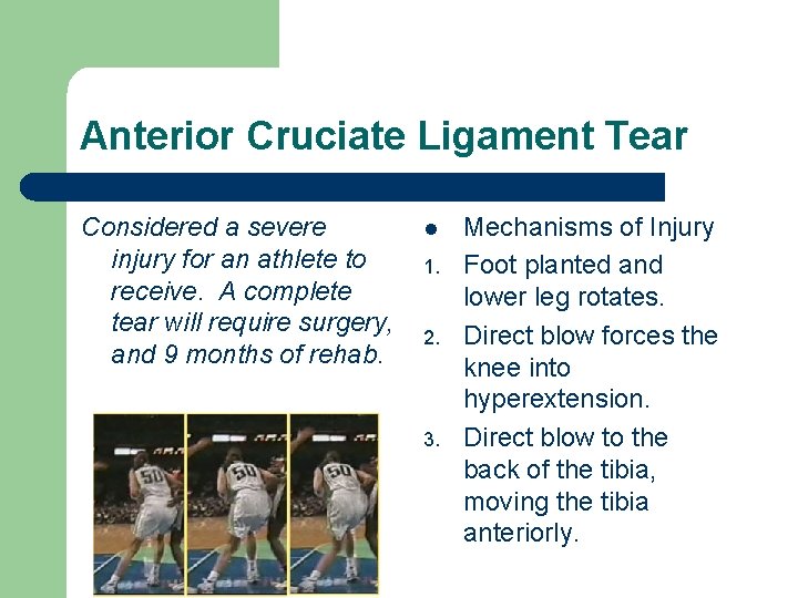 Anterior Cruciate Ligament Tear Considered a severe injury for an athlete to receive. A