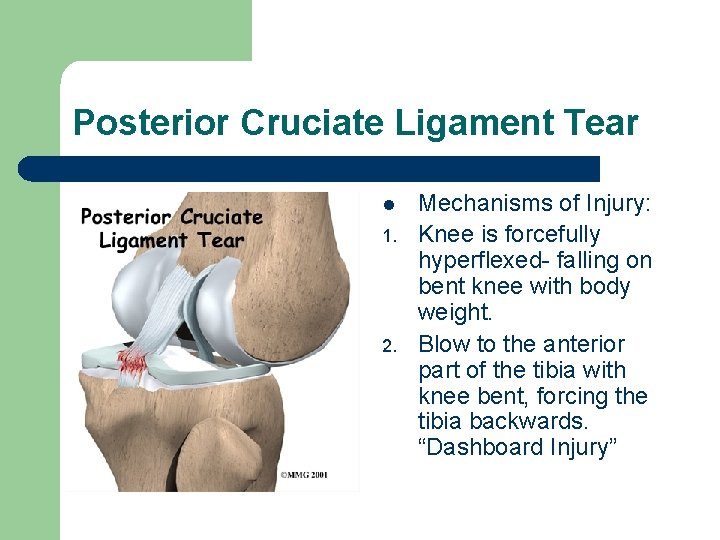 Posterior Cruciate Ligament Tear l 1. 2. Mechanisms of Injury: Knee is forcefully hyperflexed-