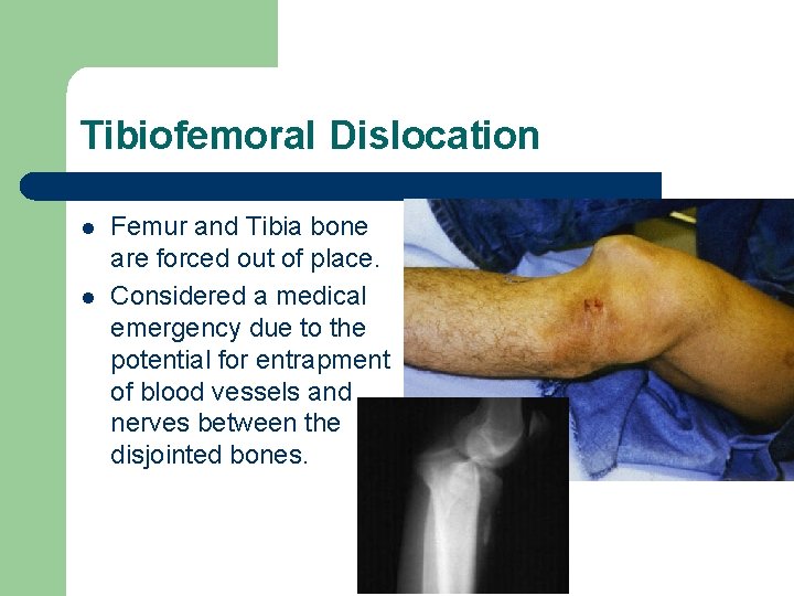 Tibiofemoral Dislocation l l Femur and Tibia bone are forced out of place. Considered