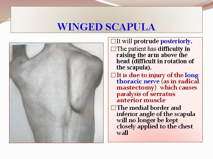 WINGED SCAPULA �It will protrude posteriorly. �The patient has difficulty in raising the arm