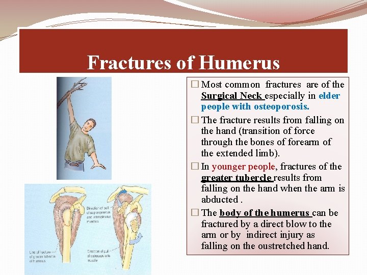 Fractures of Humerus � Most common fractures are of the Surgical Neck especially in