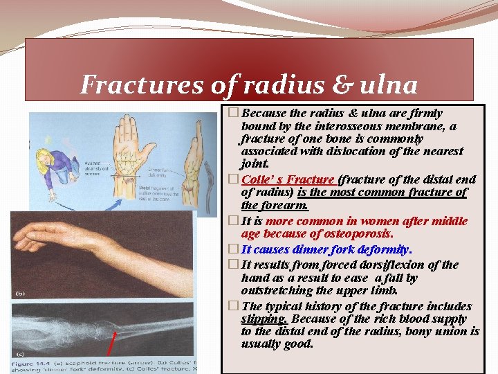 Fractures of radius & ulna � Because the radius & ulna are firmly bound