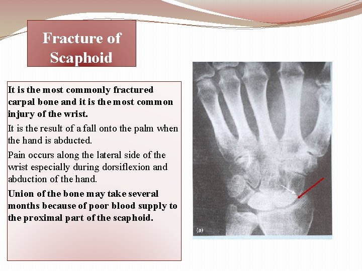 Fracture of Scaphoid It is the most commonly fractured carpal bone and it is