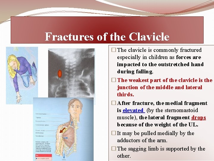 Fractures of the Clavicle � The clavicle is commonly fractured especially in children as