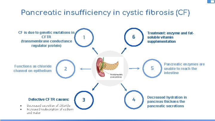 Pancreatic insufficiency in cystic fibrosis (CF) CF is due to genetic mutations in CFTR