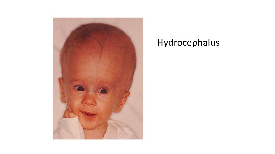 Hydrocephalus 