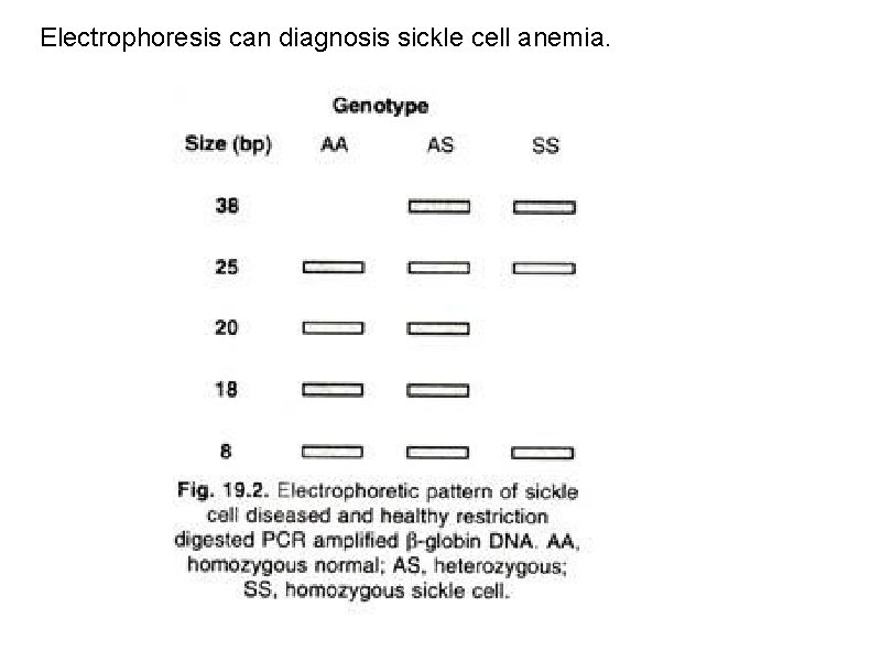 Electrophoresis can diagnosis sickle cell anemia. 