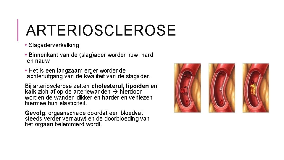 ARTERIOSCLEROSE • Slagaderverkalking • Binnenkant van de (slag)ader worden ruw, hard en nauw •