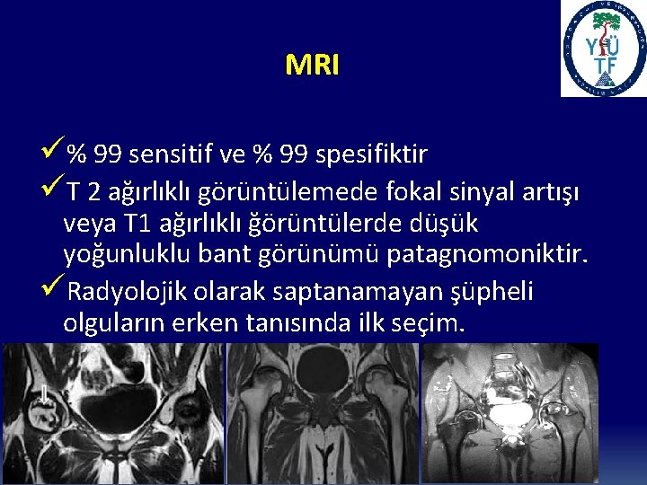 MRI ü% 99 sensitif ve % 99 spesifiktir üT 2 ağırlıklı görüntülemede fokal sinyal