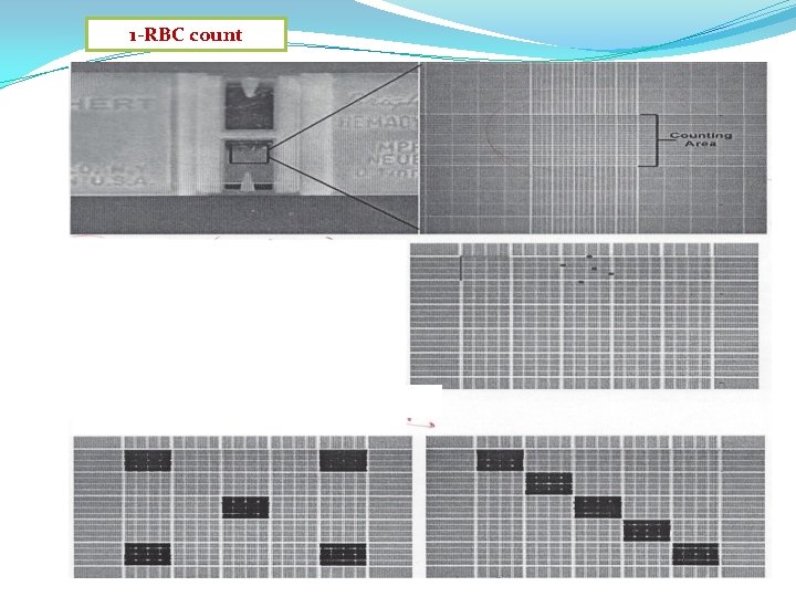 1 -RBC count 