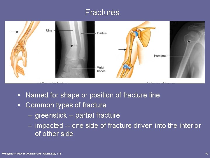 Fractures • Named for shape or position of fracture line • Common types of