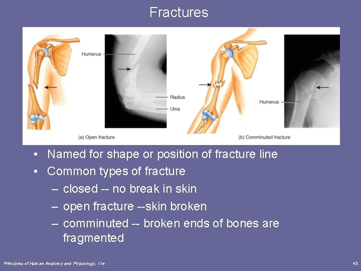 Fractures • Named for shape or position of fracture line • Common types of