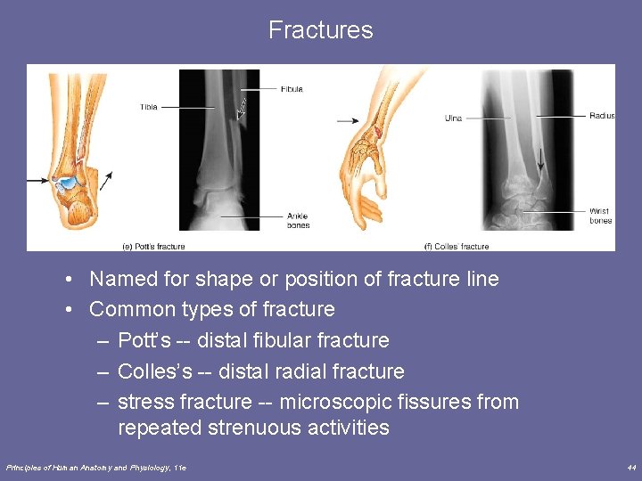 Fractures • Named for shape or position of fracture line • Common types of