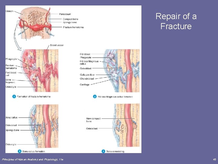 Repair of a Fracture Principles of Human Anatomy and Physiology, 11 e 45 