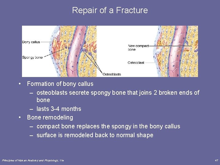 Repair of a Fracture • Formation of bony callus – osteoblasts secrete spongy bone