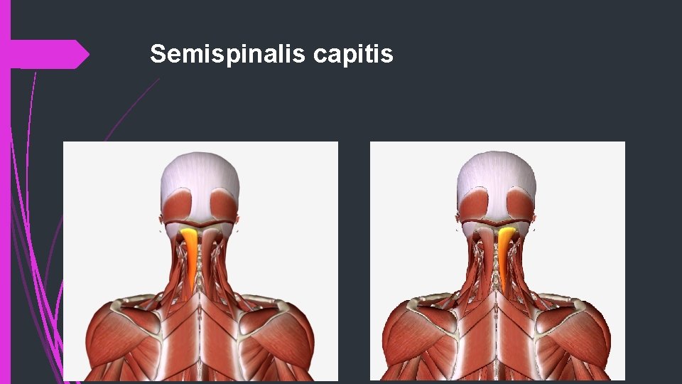 Semispinalis capitis 