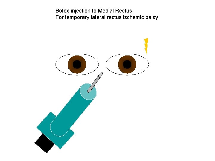 Botox injection to Medial Rectus For temporary lateral rectus ischemic palsy 