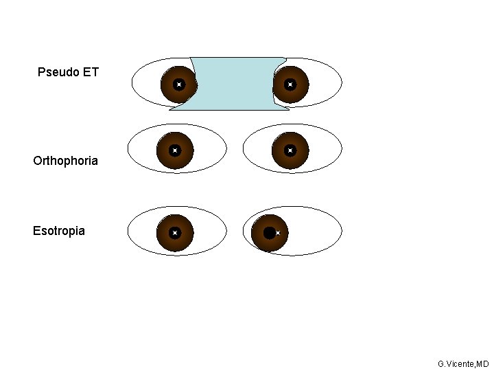 Pseudo ET Orthophoria Esotropia G. Vicente, MD Pseudo ET Orthophoria Esotropia G. Vicente, MD