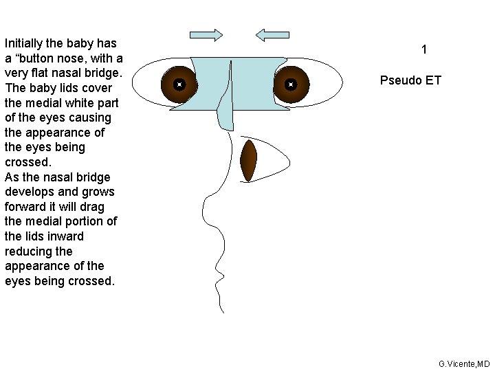 Initially the baby has a “button nose, with a very flat nasal bridge. The