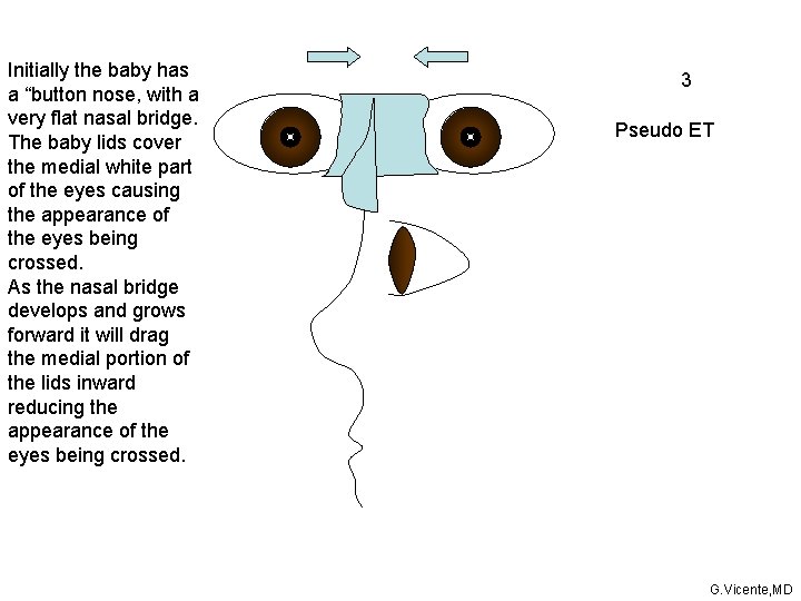 Initially the baby has a “button nose, with a very flat nasal bridge. The Initially the baby has a “button nose, with a very flat nasal bridge. The