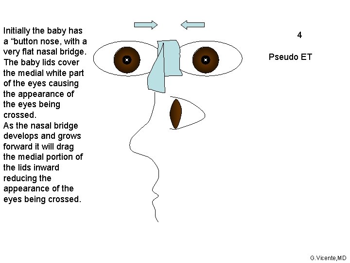 Initially the baby has a “button nose, with a very flat nasal bridge. The