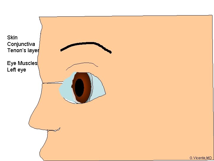 Skin Conjunctiva Tenon’s layer Eye Muscles Left eye G. Vicente, MD 