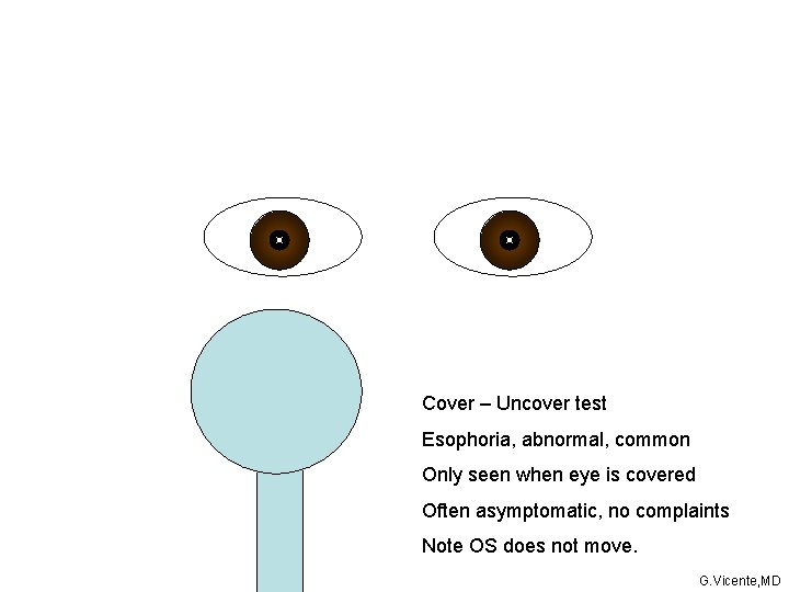 Cover – Uncover test Esophoria, abnormal, common Only seen when eye is covered Often