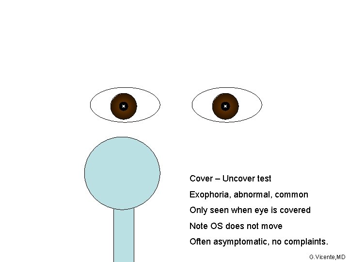 Cover – Uncover test Exophoria, abnormal, common Only seen when eye is covered Note