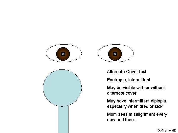 Alternate Cover test Exotropia, intermittent May be visible with or without alternate cover May