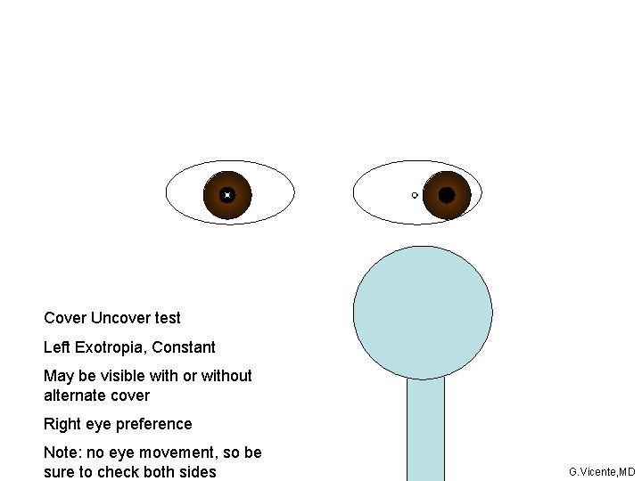 Cover Uncover test Left Exotropia, Constant May be visible with or without alternate cover